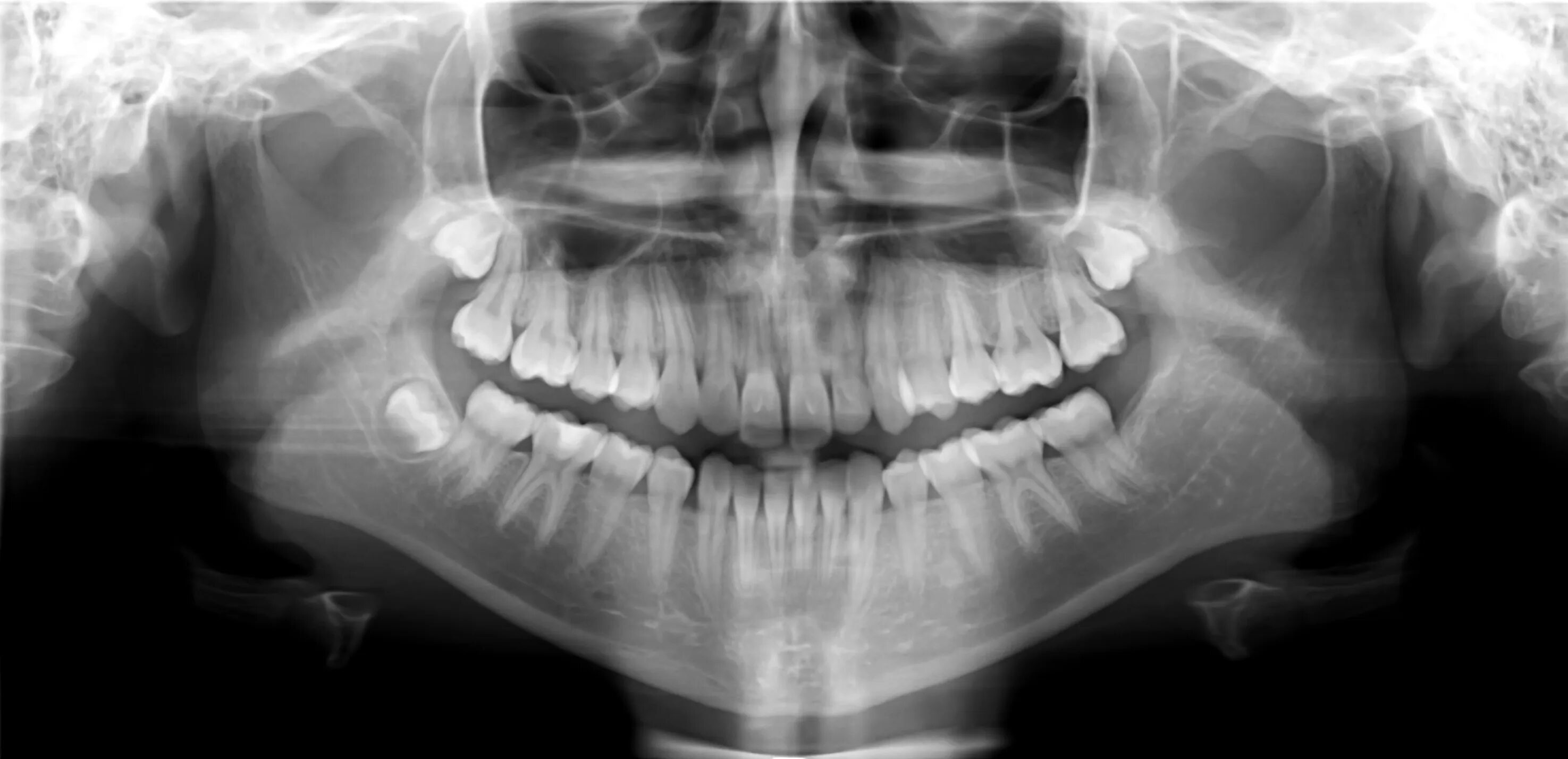 Снимок зубов видное. Ортопантомограмма челюсти. Ортопантомограмма кариес. ОПТГ кариес снимок зубов.