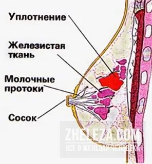 Мастопатия узлы