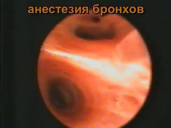 Диффузный эндобронхит. Гнойный эндобронхит на бронхоскопии. катаральный эндобронхит на бронхоскопии.