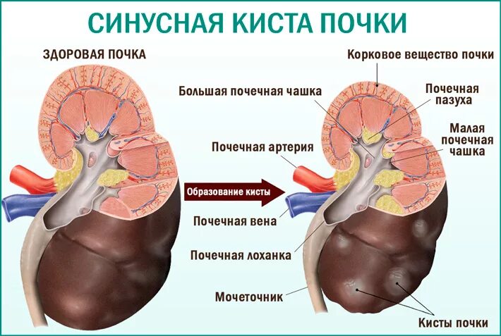 Изменение синусов обеих почек. Киста почки Синусоидная. Киста синуса правой почки 14 мм. Кисты почечного синуса почек.