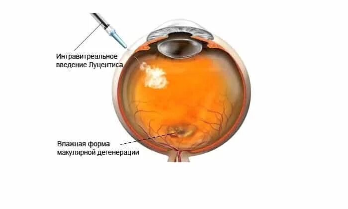 Озурдекс имплантат для интравитреального. Интравитреальное введение луцентиса. интравитреальные инъекции в глаз. интравитреальные инъекции ингибиторов ангиогенеза. интравитреальное введение озурдекс.