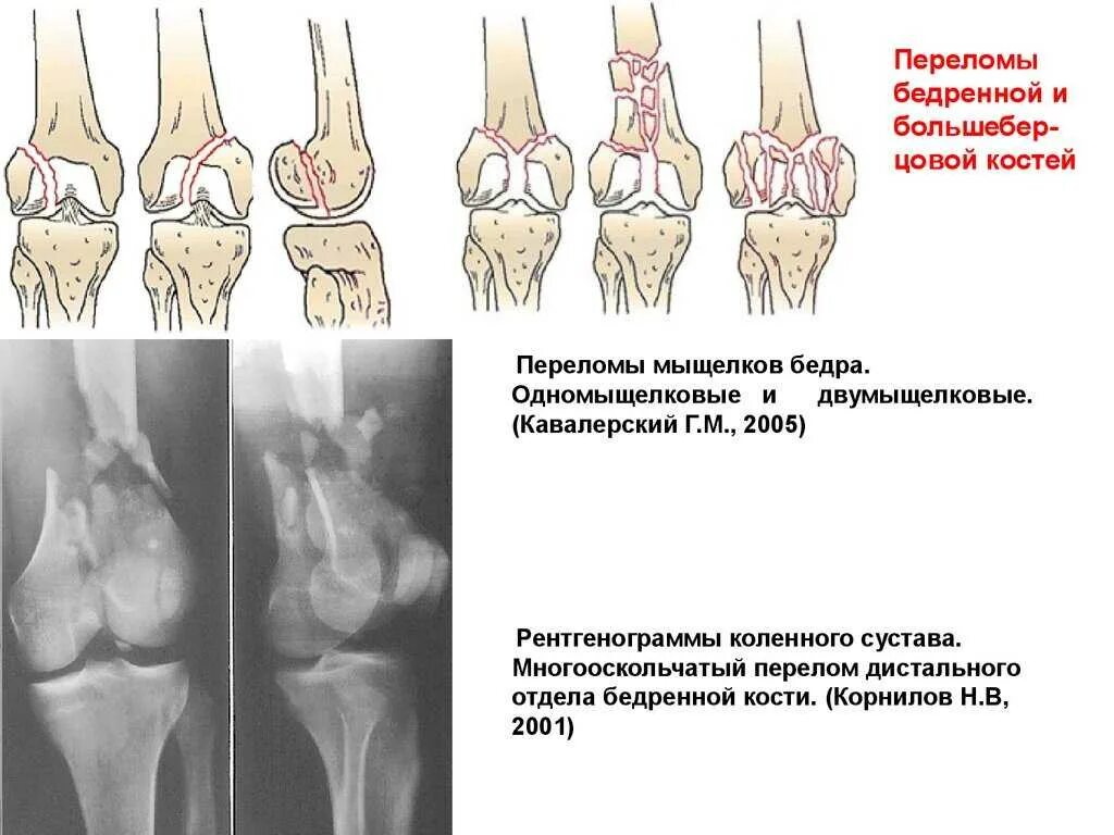 Латеральный мыщелок бедренной. Внутрисуставной перелом большеберцовой кости. Компрессионный перелом наружного мыщелка большеберцовой кости. Перелом мыщелка большеберцовой кости. Перелом большеберцовой кости рентген.