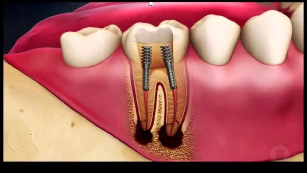 Root canal. Канкрементдзгвц пульпит. Трехканальный пульпит.