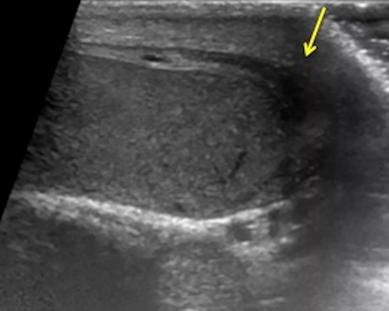Образование придатка яичка. Анатомия придатка яичка на УЗИ. Придаток левого яичка УЗИ.