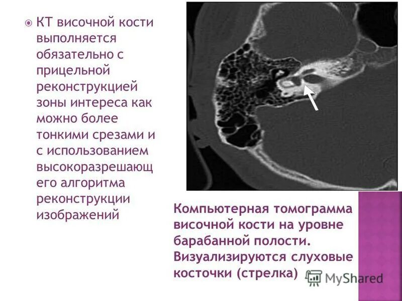 Мрт анатомия среднего уха. Кт внутреннего уха височных костей. Тугоухость кт. Кт височной кости патологии внутреннего уха. Анатомия височной кости кт.