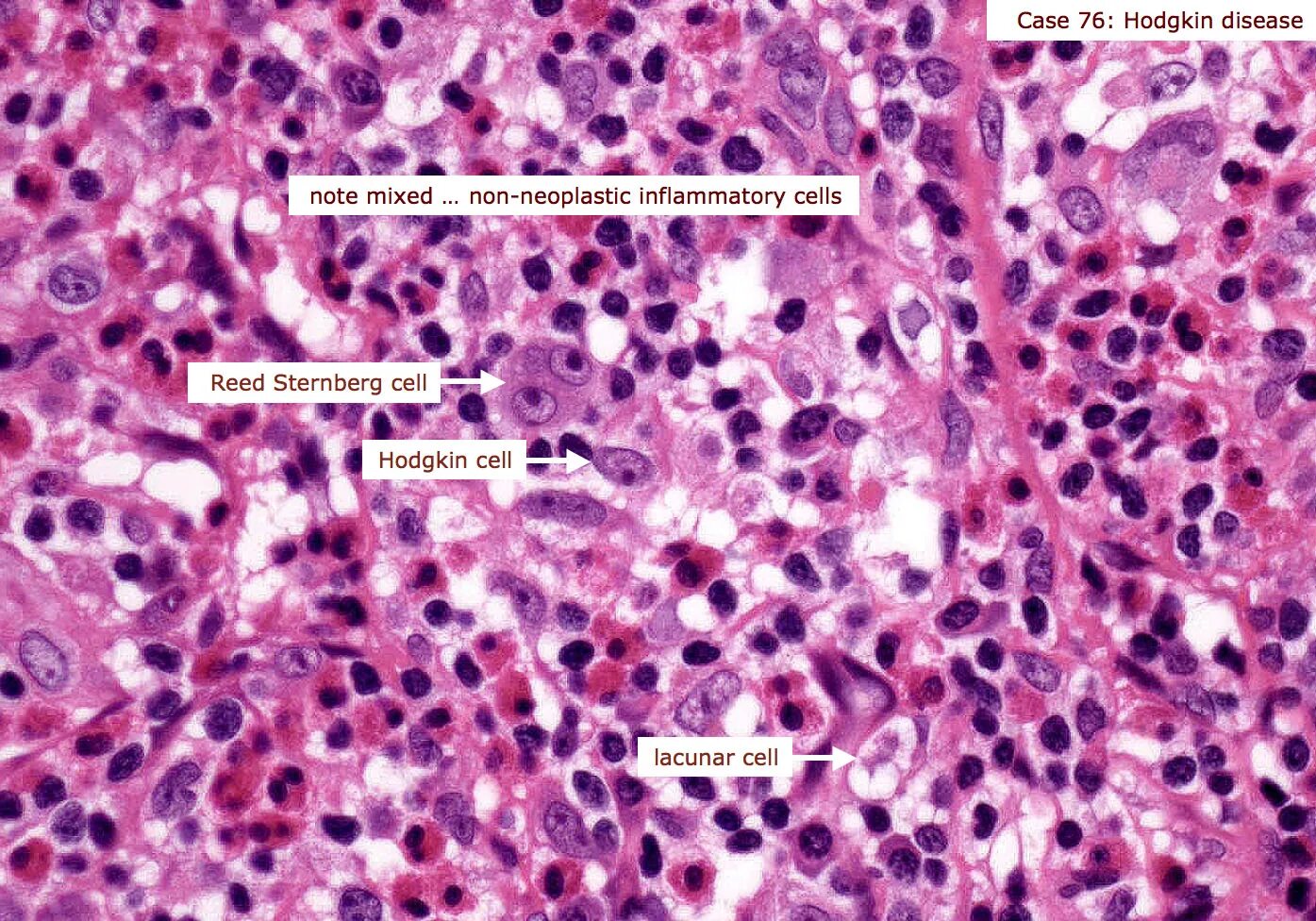 Лимфома лимфатические узлы. Селезенка при лимфогранулематозе микроскопия. Клетки Ходжкина гистология. Клетки Березовского-Штернберга гистология. Селезенка при лимфоме Ходжкина микропрепарат.