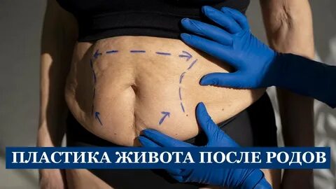Пластику живота