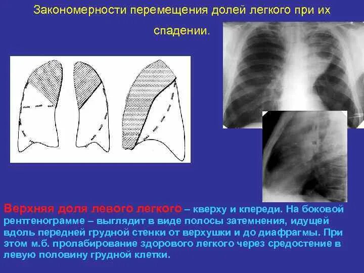 Тень в верхней доле. Доли левого легкого на рентгенограмме. Доли легкого рентген. Доли легких схема рентгенограммы.