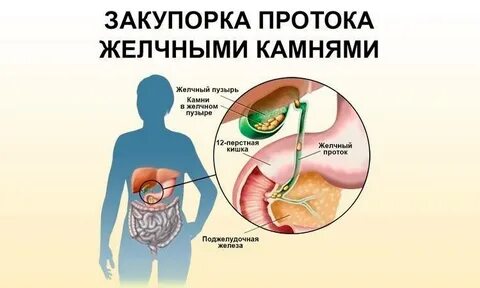 Обструкция желчевыводящих путей что это