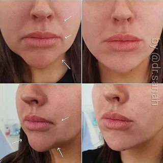 Можно колоть губы во время месячных