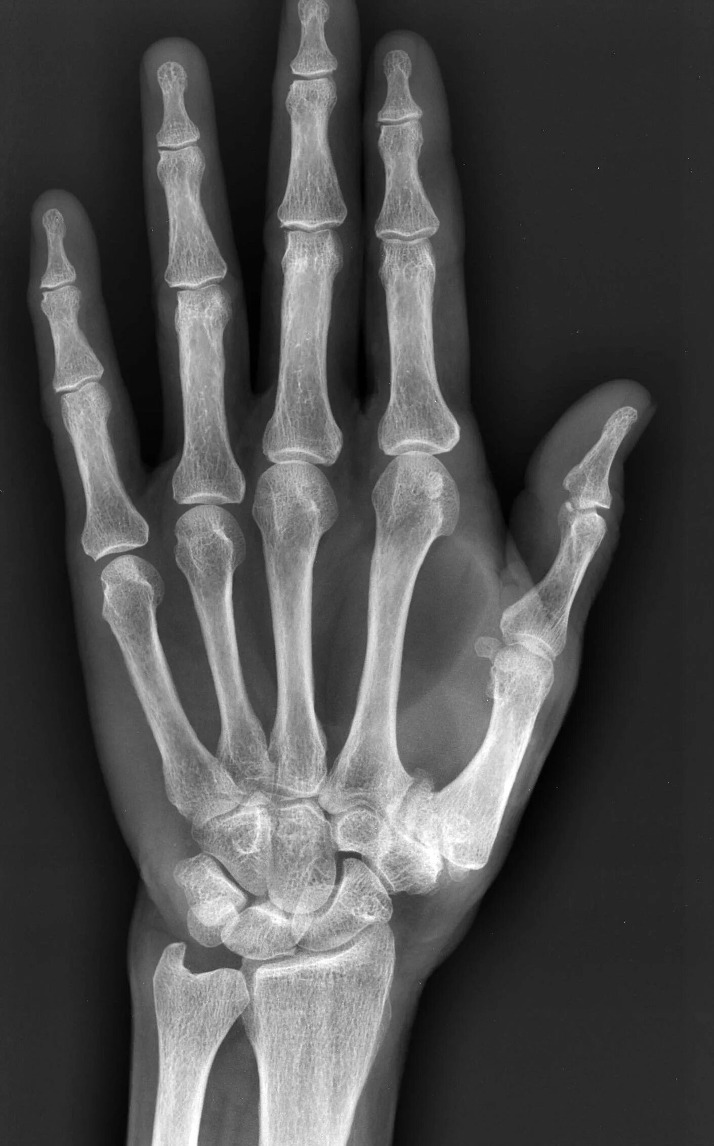 Трещина фаланги. Перелом фаланги пальца рентген. Краевой перелом фаланги пальца руки. Краевой перелом ногтевой фаланги пальца руки. Перелом 3 фаланги пальца на руке.
