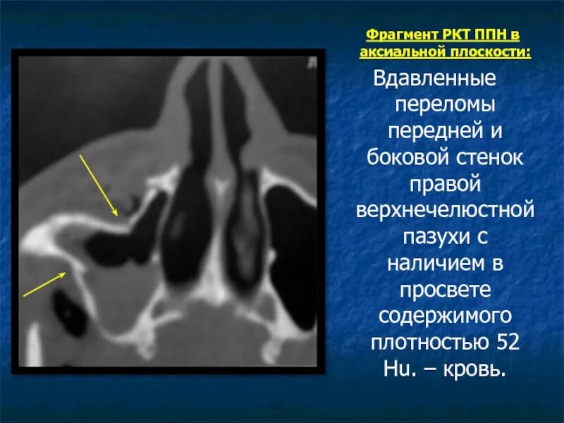 Что такое ркт. РКТ придаточных пазух носа. Перелом передней стенки верхнечелюстной пазухи. Перелом передней стенки правой верхнечелюстной пазухи.