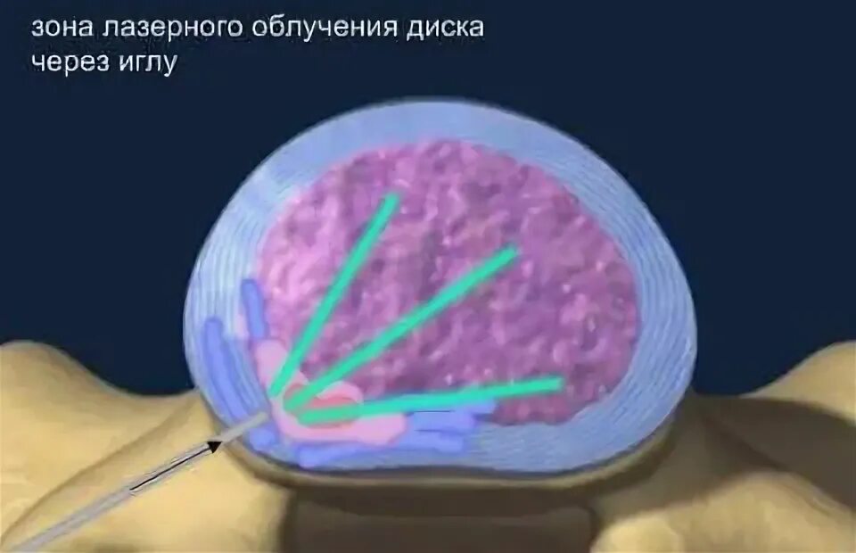 Убрать грыжу лазером. Убрать грыжу лазером