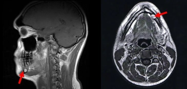 Магнитно резонансная томография челюсти. Кт 3d верхней и нижней челюсти. Опухоль кости челюсти на кт. На кт видно опухоль
