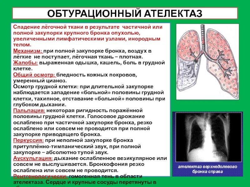 Спадение бронха