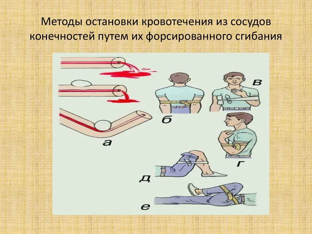 Методы остановки кровотечения из сосудов конечностей. Остановка кровотечения из сосуда. Методы остановки кровотечений из артерий. Способы остановки внутреннего кровотечения.