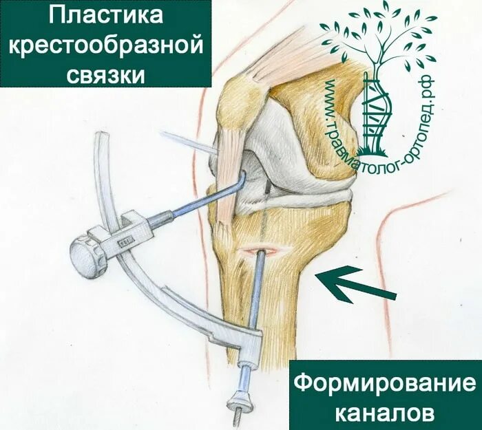 Разрыв передней крестообразной связки операция. Артропластика ПКС коленного сустава. Аутотрансплантация связки коленного сустава. Крестовидная связка коленного сустава. Симптомы крестообразной связки коленного сустава