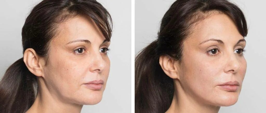 Подтяжка овала отзывы. Подтяжка овала отзывы. Пластическая операция по подтяжке лица. Мезонити для подтяжки лица. Подтяжка овала отзывы.