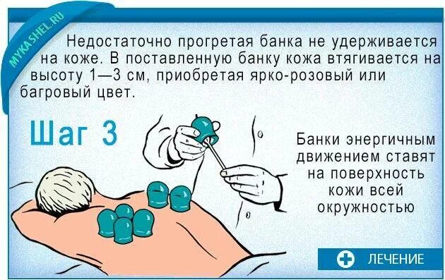При каком кашле ставят банки. Схема постановки банок на спину при бронхите. постановка банок на спину при кашле. схема постановки банок при бронхите. как ставить банки на спину при кашле.