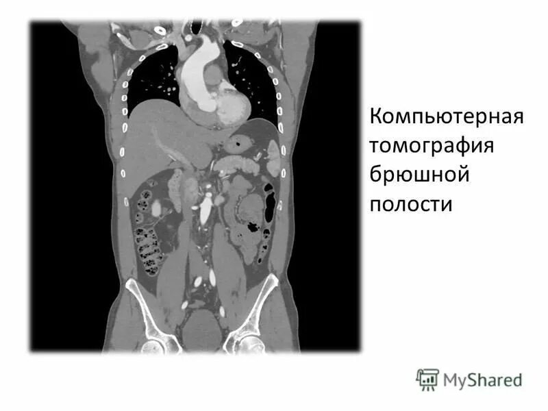 Компьютерная томография (кт) брюшной полости. Кт брюшной полости аксиальный срез. Кт томография брюшной полости. Кт брюшной полости с контрастом.