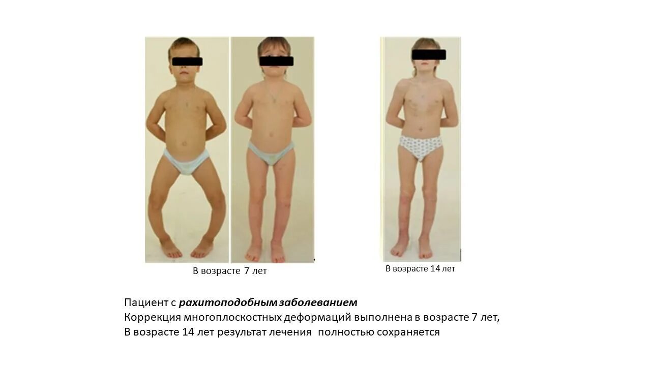 Витамин д дефицитный рахит у детей. Рахит у детей дефицит витамина д. Рахит у детей раннего возраста. Методы исследования при рахите. Рахит у ребенка после года.