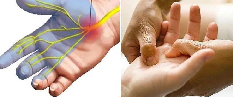 Парестезия что это такое симптомы. Парестезия проявление. Парестезия (остаточная анестезия). Парестезия конечностей. Парестезия конечностей верхних.