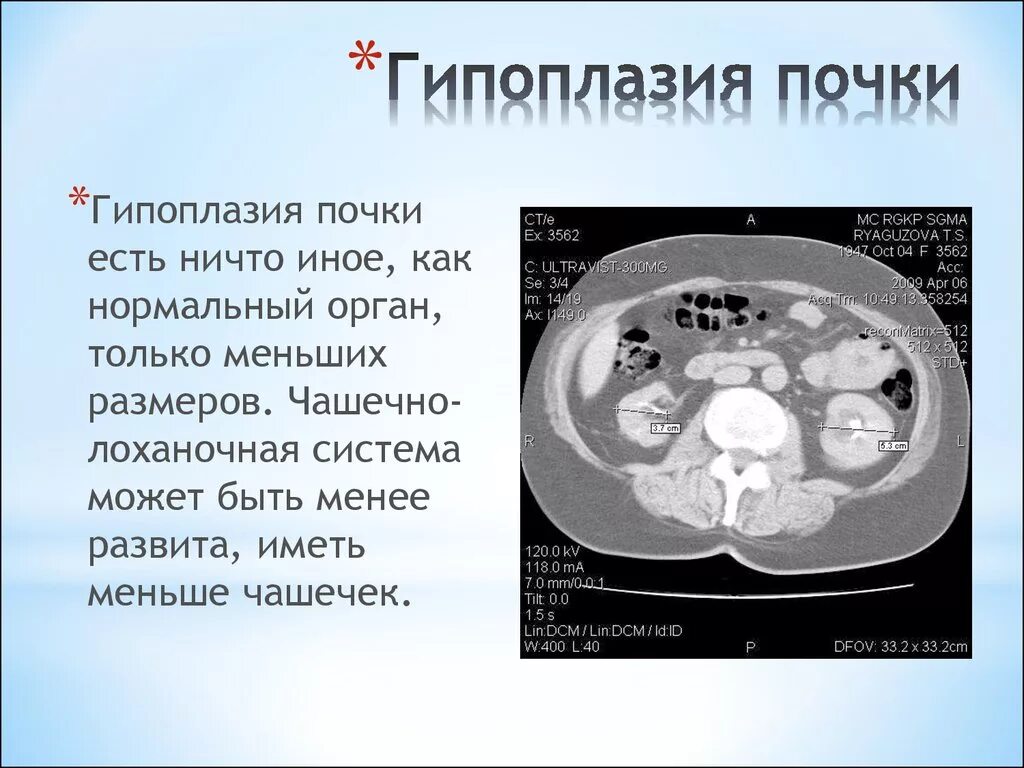 Дифференциальный диагноз гипоплазии почки. Гипоплазия левой почки. Врожденная гипоплазия почки. Правая почка меньше левой