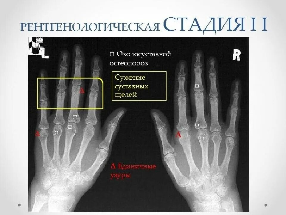 Артрит рентгенологические стадии. Ревматоидный артрит кисти рентген. Ревматоидный артрит кисти рентген стадии. Узуры ревматоидного артрита. Ревматоидный артрит 1 стадия на рентгене.