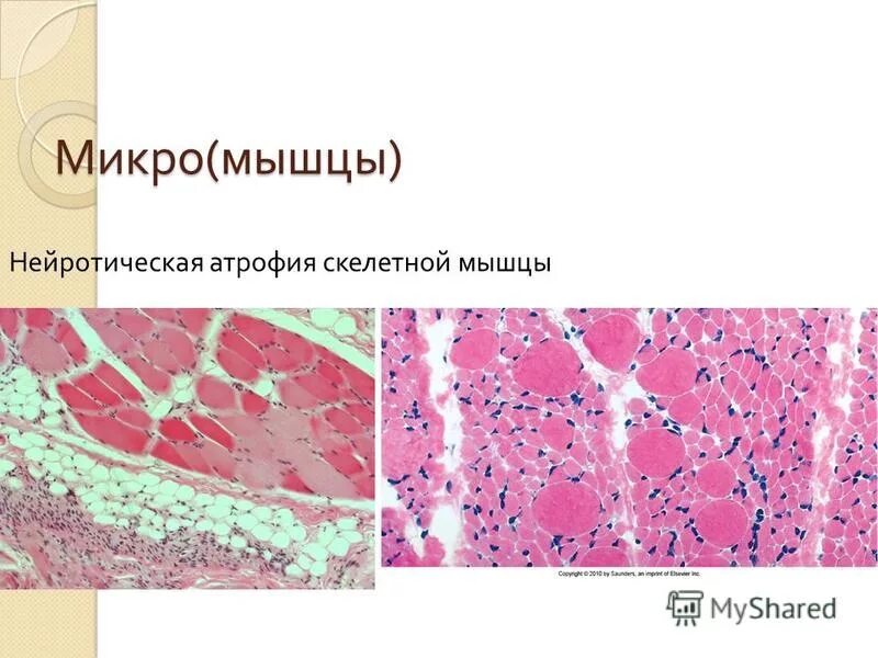 Атрофия скелетных мышц. Нейротрофическая атрофия. Нейротрофическая атрофия скелетной мышцы микропрепарат. Нейротическая атрофия мышц микропрепарат. Атрофирование мышечной ткани.