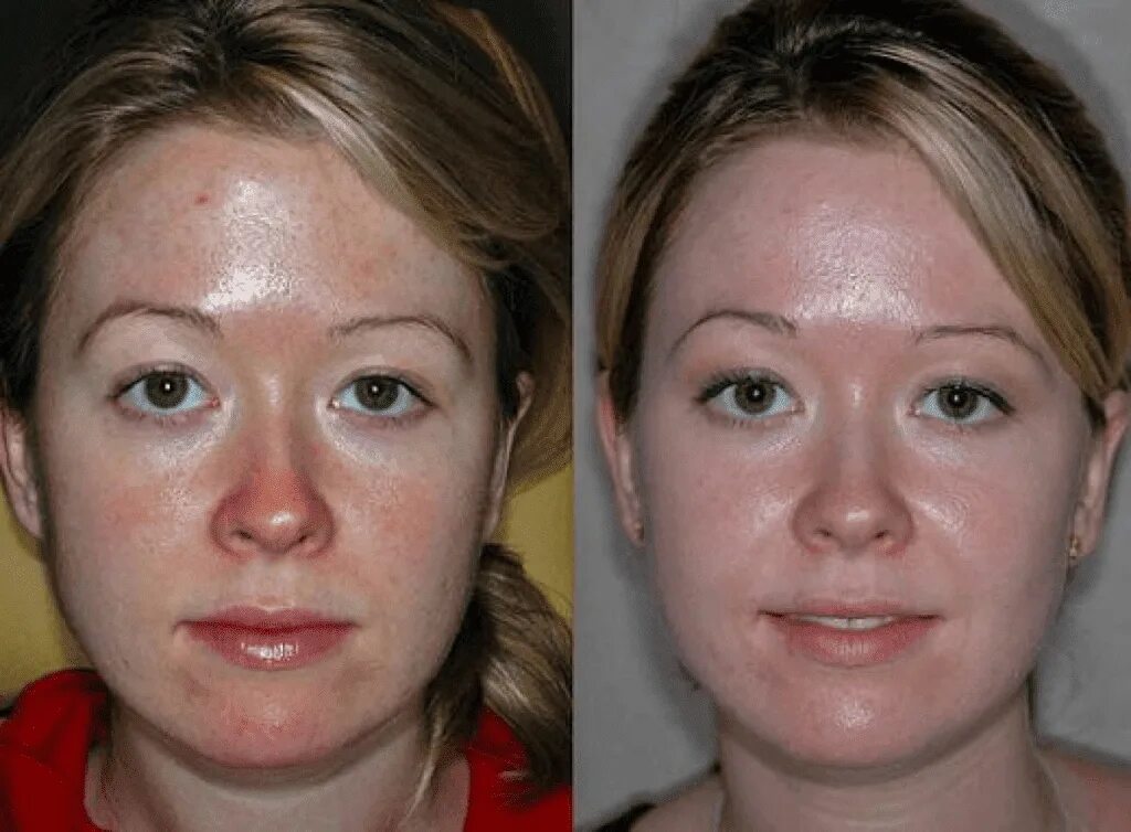 Маски для лица до и после. Лазерная дермабразия розацеа. Ретиноловый пилинг до и после. Пировиноградный пилинг ожог.