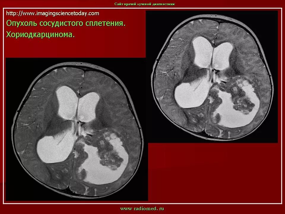 Киста сосудистого сплетения слева. Опухоли сосудистого сплетения. Опухоль сосудистого сплетения головного мозга. Папиллома сосудистого сплетения мрт. Опухоли хориоидного сплетения.