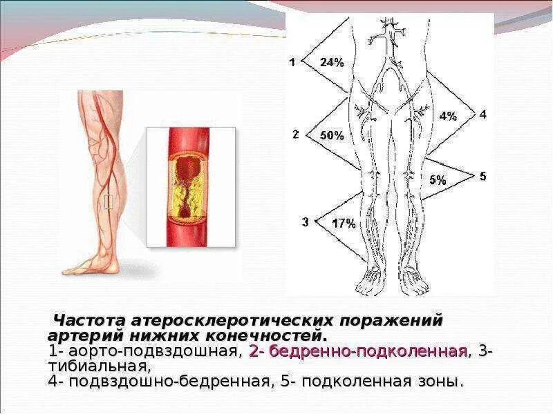 Атеросклеротическое поражение нижних конечностей. Атеросклеротическое поражение артерий нижних конечностей. Заболевания сосудов нижних конечностей.