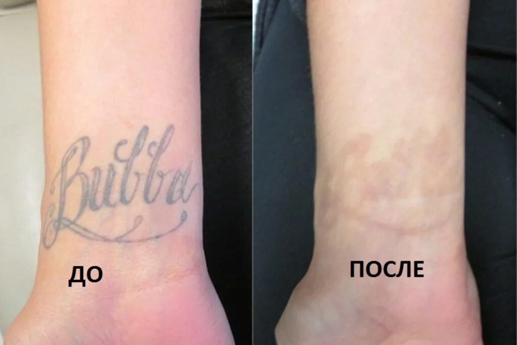 Можно вывести татуировку. Сведение тату до и после.
