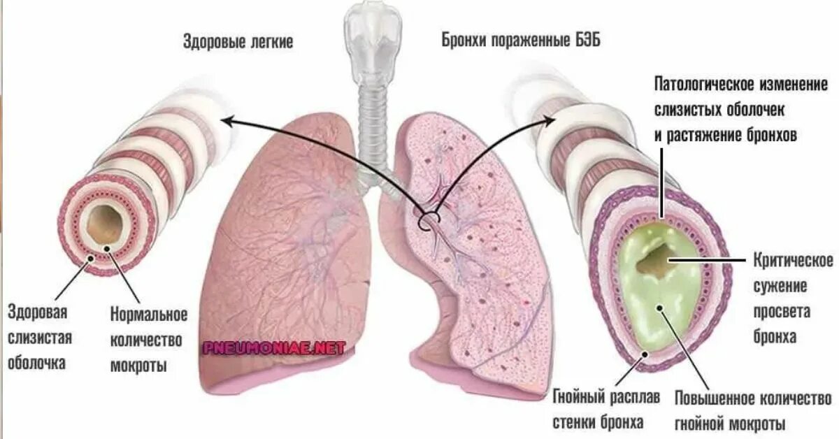 Как вывести мокроту из бронхов у взрослого. Бронхоэктатическая болезнь легких патогенез. Бронхоэктатическая болезнь вид мокроты. Бронхоэктатической болезни мокрота. Этиология бронхоэктатической болезни легких.