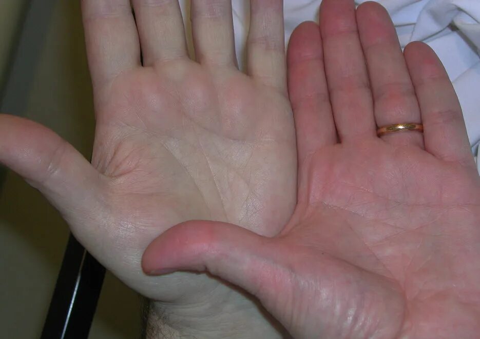 Бледный больной человек. Пальмарная эритререма. Пальмарная Эритея рук. Пальмарная эритема руки.