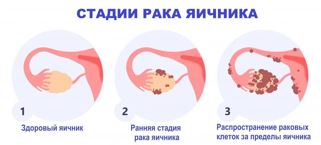Онкология яичников у женщин. Карцинома яичников 4 стадия. Карцинома яичника стадия. Злокачественная опухоль яичников у женщин. Опухоль яичника 4 стадии.