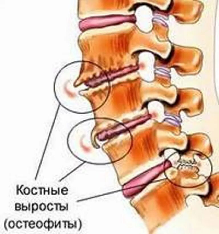 Остеофиты позвоночника l1-s1. Остеофиты l4 l5 позвонков. Остеофиты позвоночника в l4. Деформирующий спондилез поясничного отдела l1 s1. Начальный спондилез