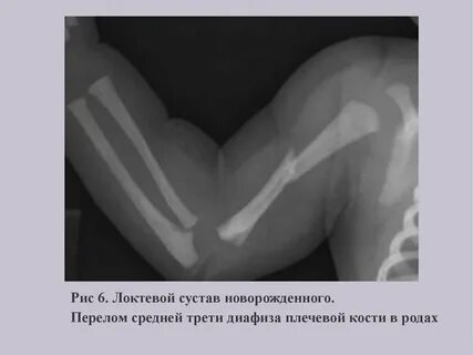 Ключица новорожденного