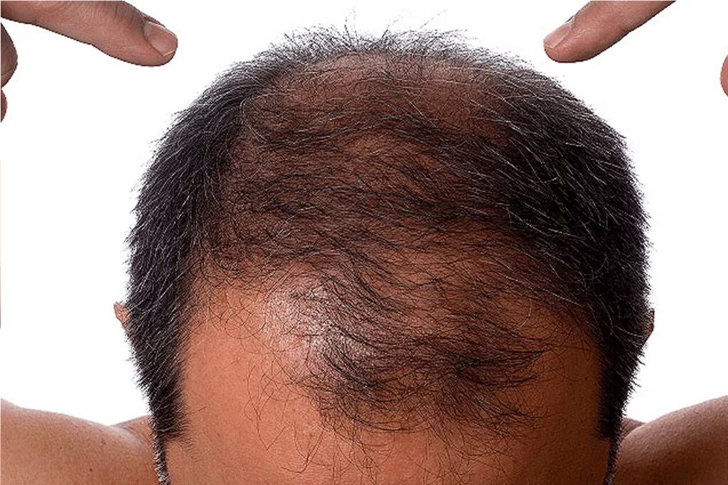 Причины выпадения волос у подростка. Неопластическая алопеция.