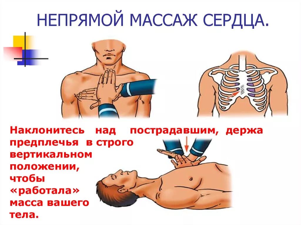 Частота надавливания при непрямом массаже. Ге прямой массаж сердца. Не примой массаж сердца. Не прямоц мпааж сердца. Не примой масаж седдца.