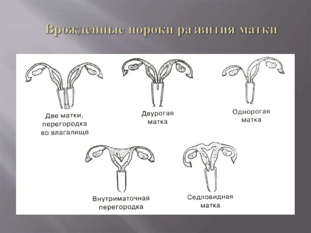 Двурогая седловидная однорогая матка. Аномалия развития матки двурогая. Двурогая матка седловидной формы. Классификация аномалий развития женских половых органов.