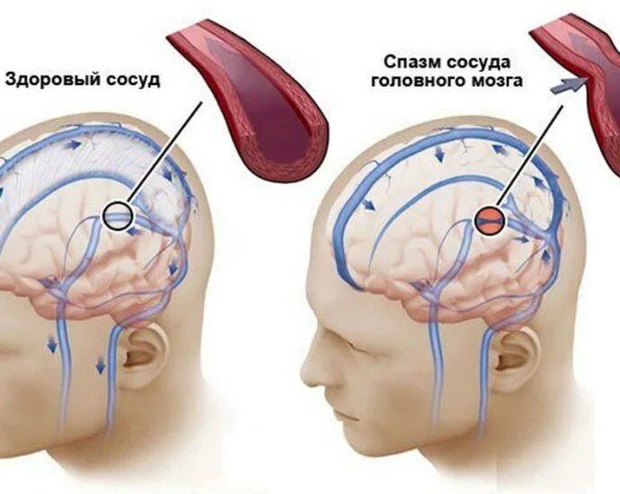 Ангиодистония сосудов. Церебральная ангиодистония сосудов головного мозга. Ангиодистония сосудов головного мозга что это такое. Церебральный ангиодистонический синдром. Ангиоспазм сосудов головного мозга.