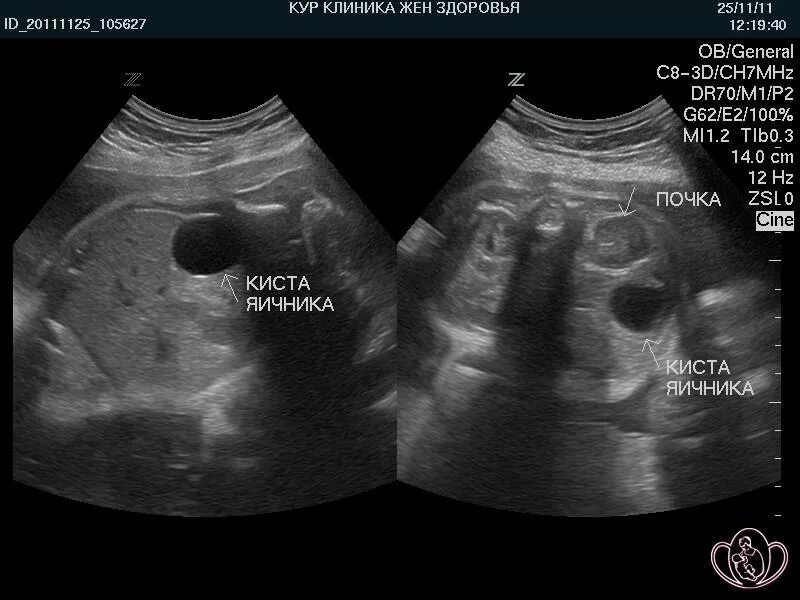 Функциональная киста яичника на УЗИ. Фолликулярная киста на УЗИ. Фолликулярные кисты яичников УЗИ. Киста яичника снимок УЗИ. Можно перепутать беременность с кистой