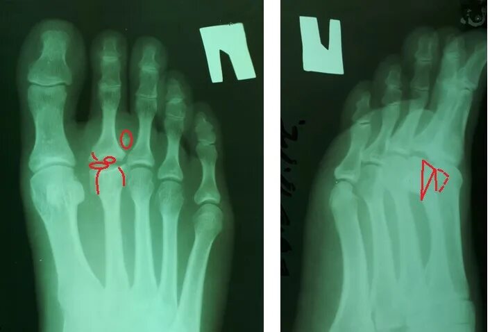 Остеохондропатия Келлера 2. Остеохондропатия 2 плюсневой кости. Болезнь Келлера 2 рентген. Остеохондропатия Келлера.