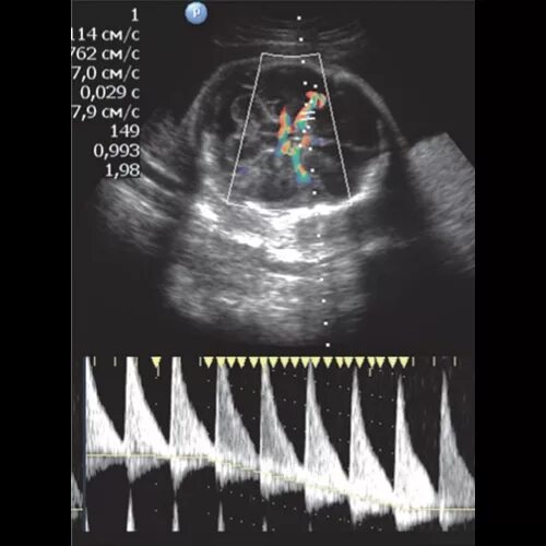 Сма плода. СМА на УЗИ. Допплер СМА плода. Средняя мозговая артерия плода. СМА на УЗИ плода что это.