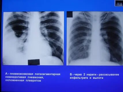Двухсторонняя пневмония у взрослого что это значит
