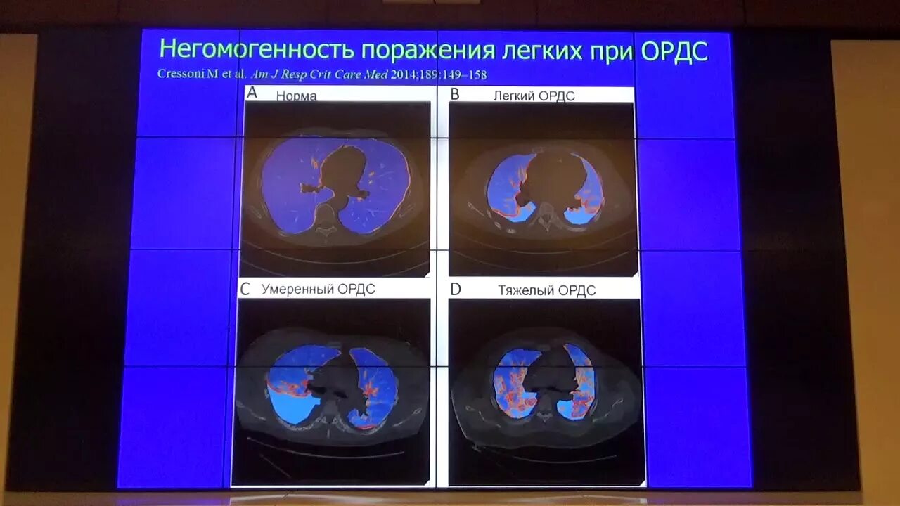 Ордс крипта. Протективная ивл. протективная вентиляция легких. ордс ивл. принципы протективной ивл.