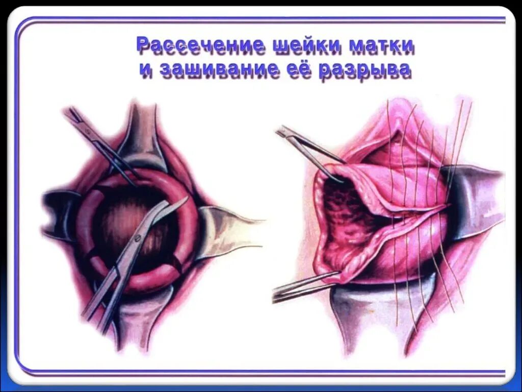 Разрыв при беременности. Послеродовой разрыв шейки матки. Разрыв после рождения ребенка.