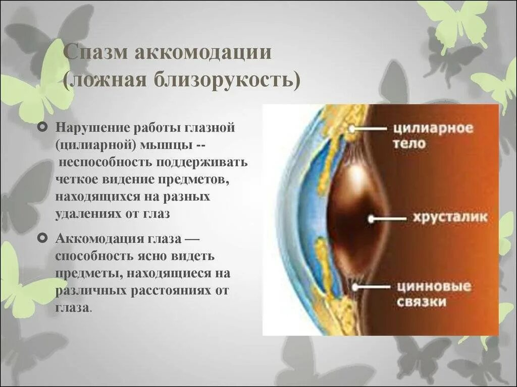 Ли спазм аккомодации. Спазм аккомодации. Спазм аккомодации глаз. Спазм аккомодации ложная близорукость. Сразм АК.