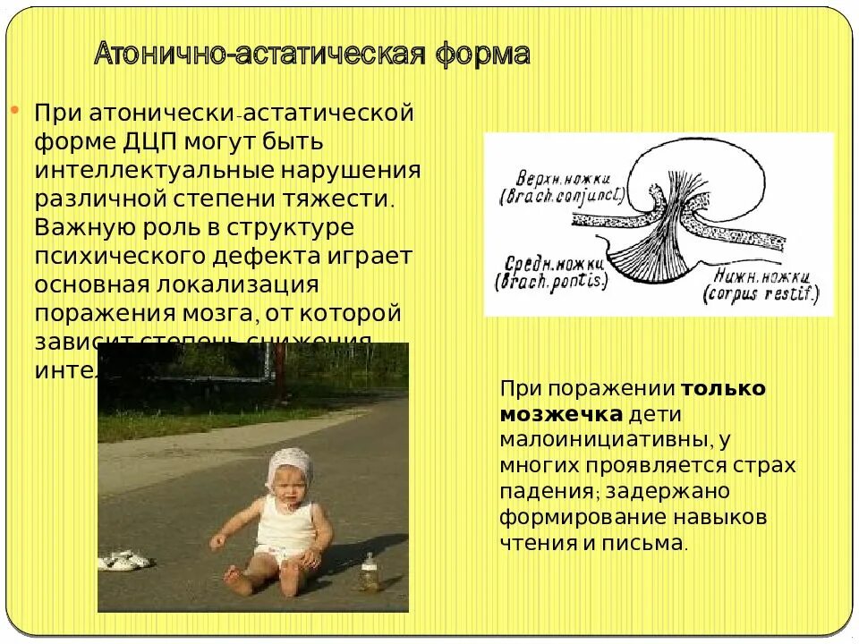 Дцп атонически астатическая. Атонически-астатическая форма дцп. детский церебральный паралич атонически-астатическая форма. формы детского церебрального паралича (дцп),. атонически-астатическая форма церебрального паралича.